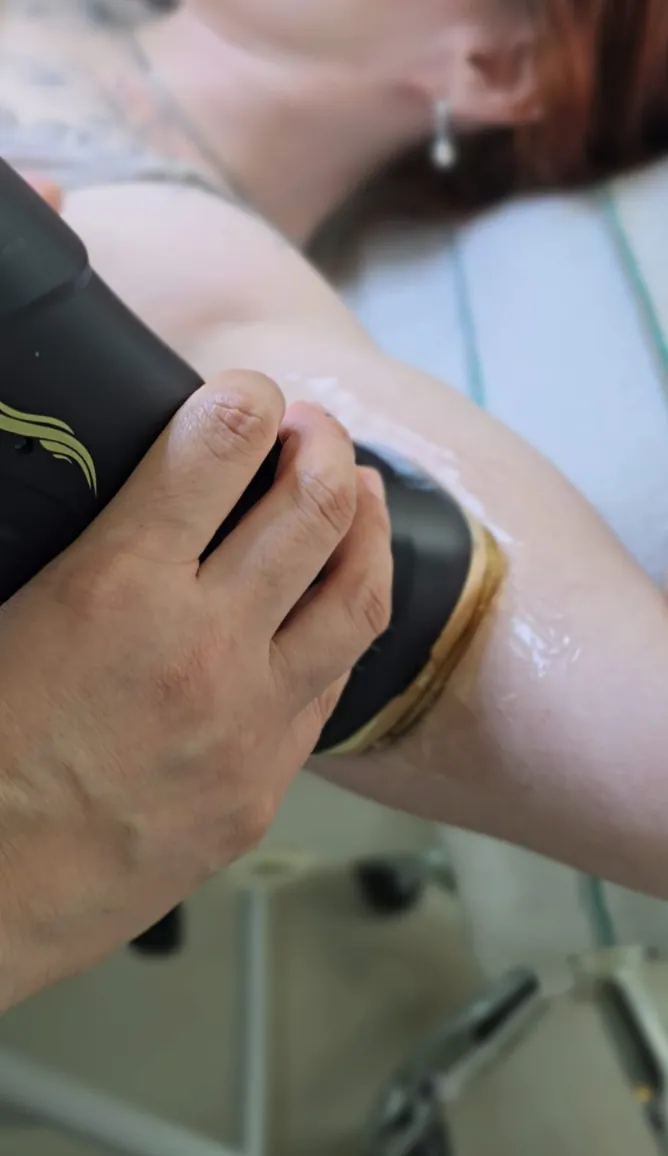 Detalle del cabezal de HIFU trabajando sobre el brazo