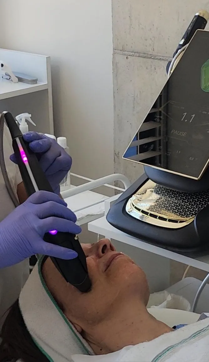 Sesión de HIFU facial en el contorno de la mandíbula