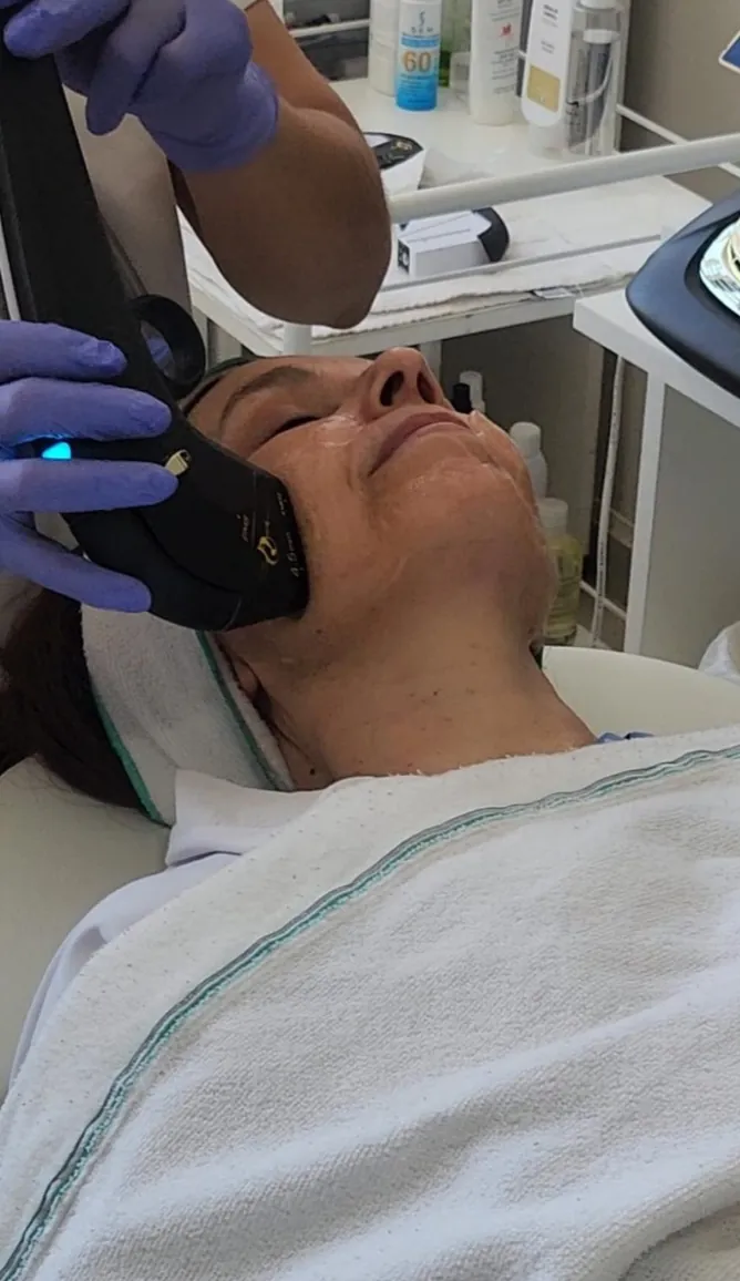 HIFU aplicado en el óvalo del rostro